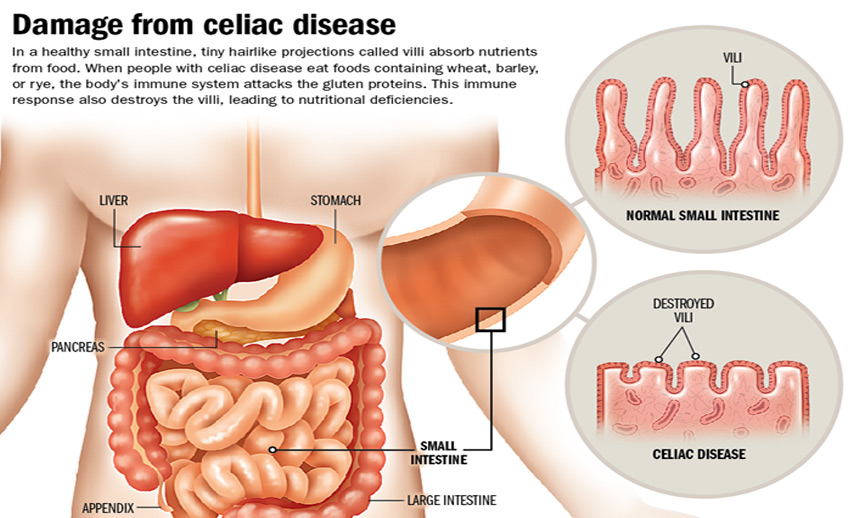 Celiac Disease Gastroenterologist Orlando